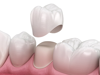 Pembroke Smile Center | Implant Overdentures, Root Canals and All-on-4 reg 